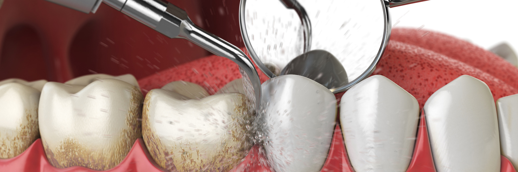 Dental cleaning removing plaque and tartar buildup from teeth during professional exam 